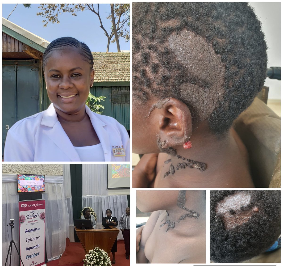 RDTCTZ's tweet photo. Dr. Cyndy Muliro did a brilliant case report on Epidermal Nevus Syndrome. A rare developmental abnormalities of  the skin, eye, nervous, skeletal, cardiovascular and urogenital  systems.
#raredermatologydiseases https://t.co/stSXPWyXuP