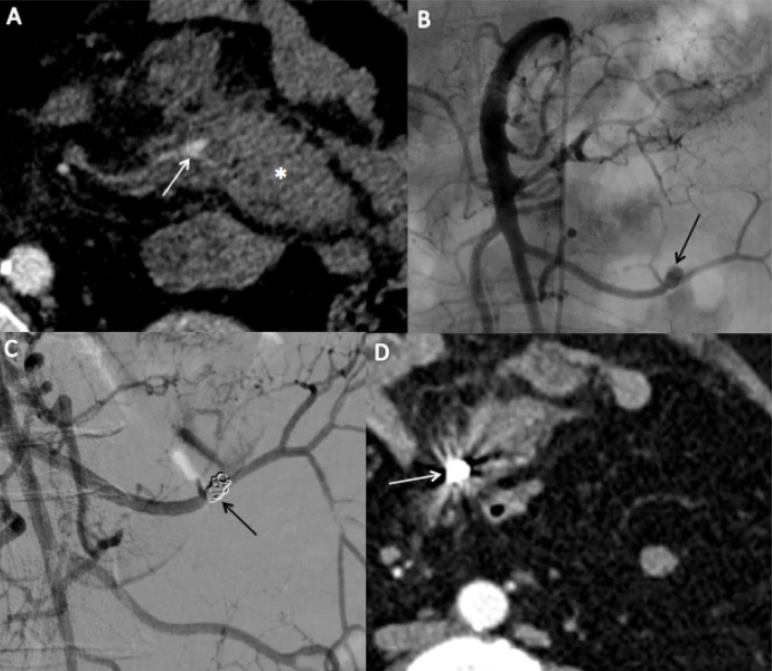 In this #originalarticle, the authors evaluated the safety and efficacy of #transarterialembolization for #mesenteric bleeding, building on the scarce literature for this alternative to emergency surgery

Read + Download here:
cvirendovasc.springeropen.com/articles/10.11…