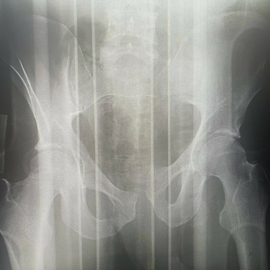 Open book pelvis fracture, torn bladder, internal bleeding, broken sacrum, L4, L5 vertebra, brain bleed…I want to be bummed out but I just can’t. I feel blessed to even be writing this 🙌🏻🙌🏻

My wife <a href="/hollysipes/">Holly Sipes</a> has been incredible. Handling everything without missing a beat.…