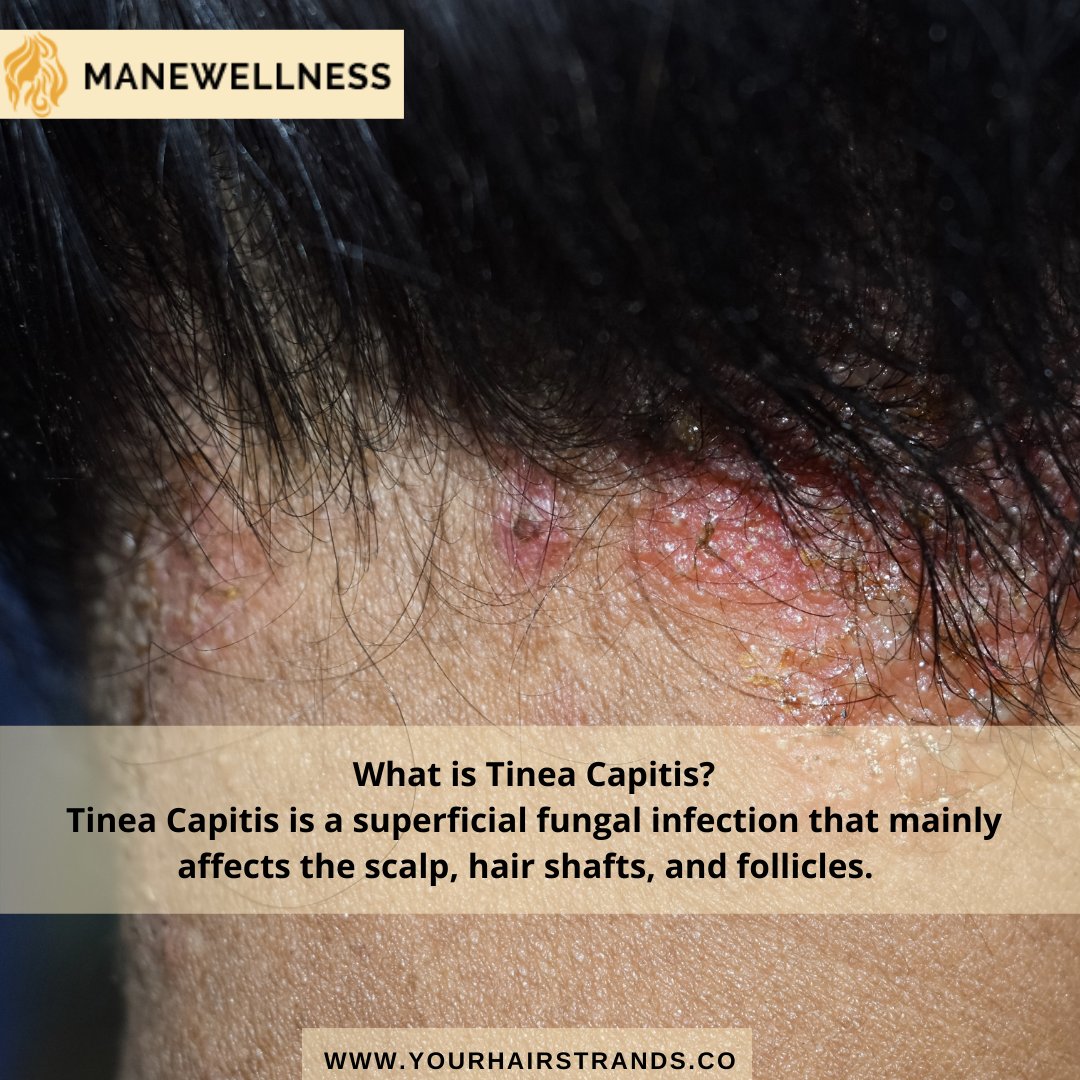 Marsha McCamey on X: Tinea Capitis presents as scaly patches that look  similar to flaking caused by seborrheic dermatitis. To know more Visit:   . . #psoriasis #eczema #acne #jerawat #skincare  #hair #