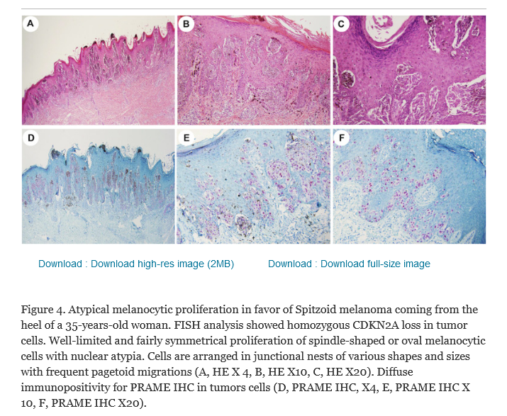 Human_Pathology's tweet photo. #HumPathol #Dermpath #PRAME #Melanoma
Fattori et al. show that when used carefully, PRAME IHC shows high sensitivity/specificity for distinguishing malignant challenging melanocytic proliferations from benign ones and could be used as an everyday tool
https://t.co/m4GWIf3opO https://t.co/YW6VrAznoD