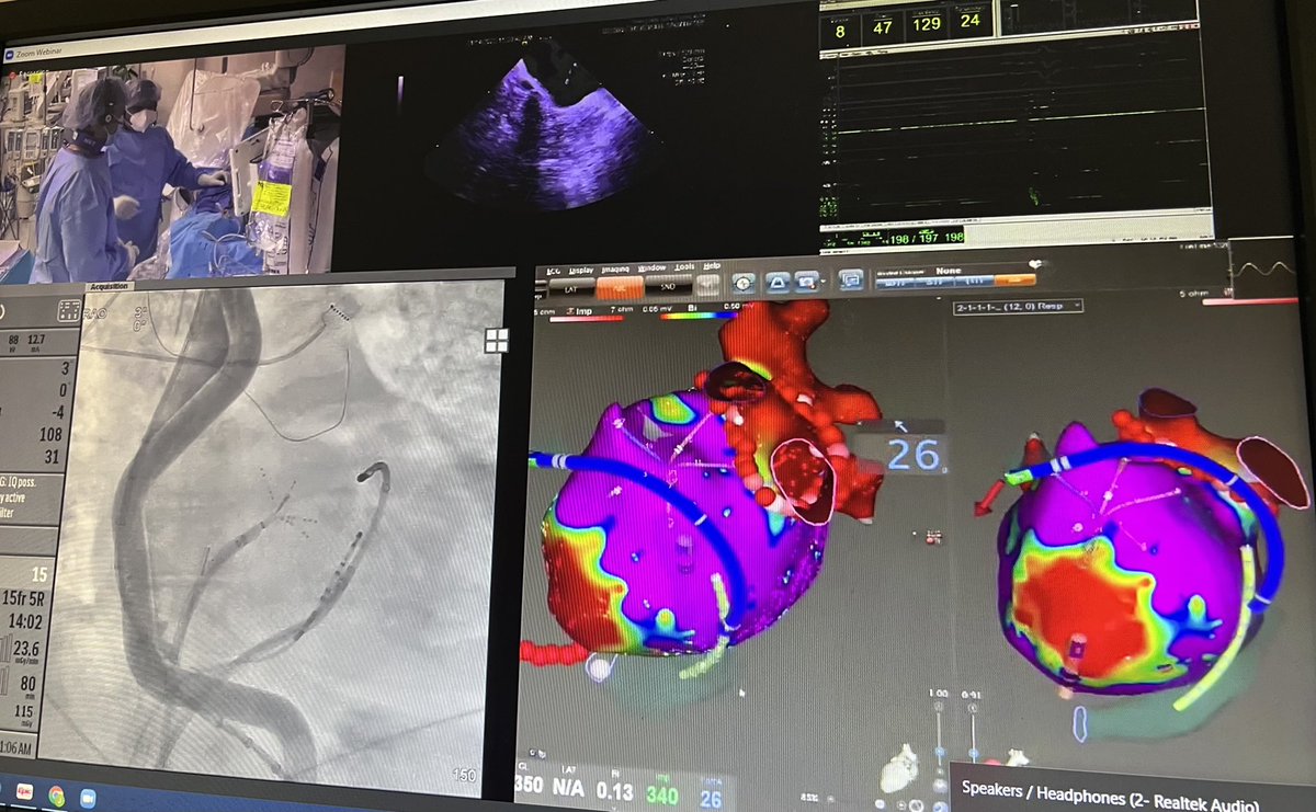 Great experience participating in live case today demonstrating VoM infusion strategy for persistent AF ablation. Previously shown to improve freedom from AF/AT/AFL and acute success and durability of mitral block. #AFSymposium2022 @VivekReddyMD @mohitkturagam @MountSinaiHeart