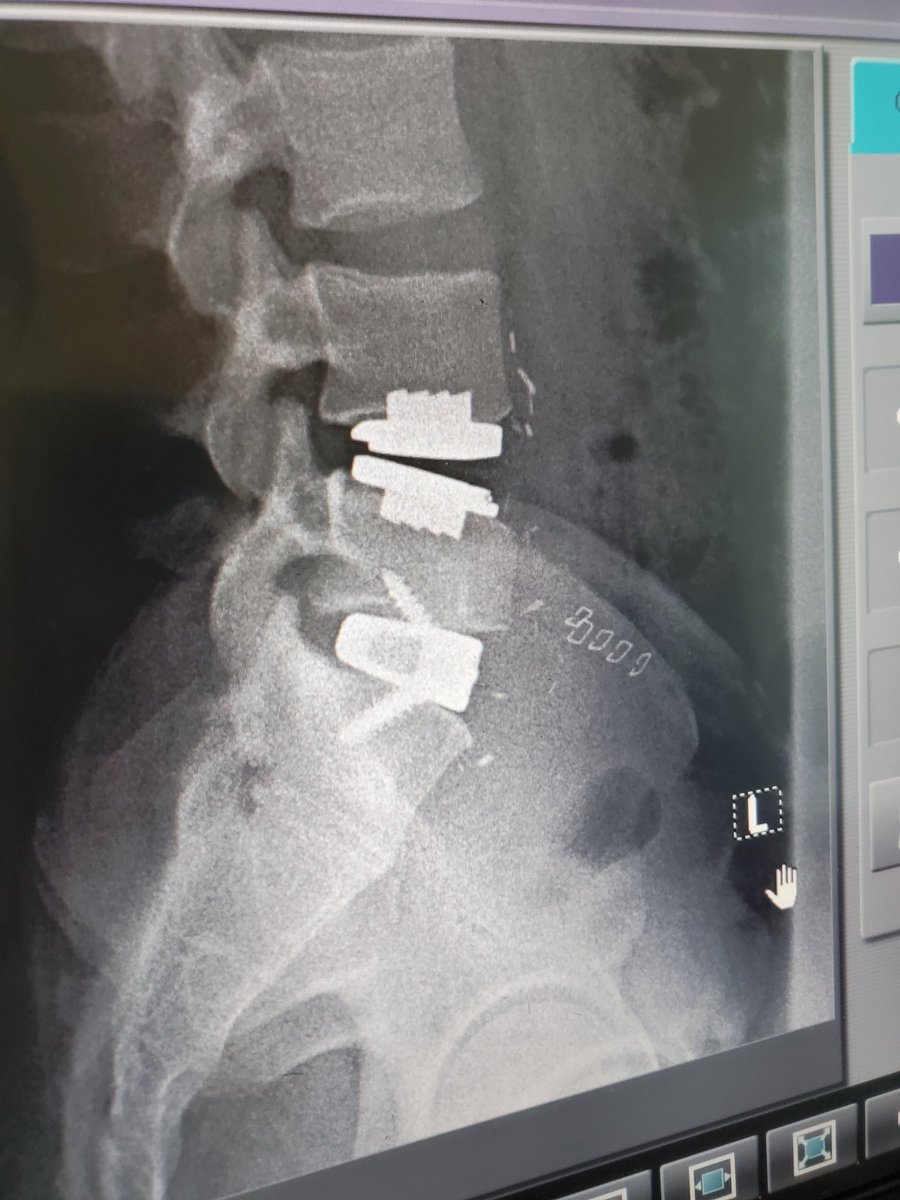 TrueeElevation's tweet image. New Xrays and as predicted my back is officially screwed 🔩🔩 🤣🤣🤣🤣🤣