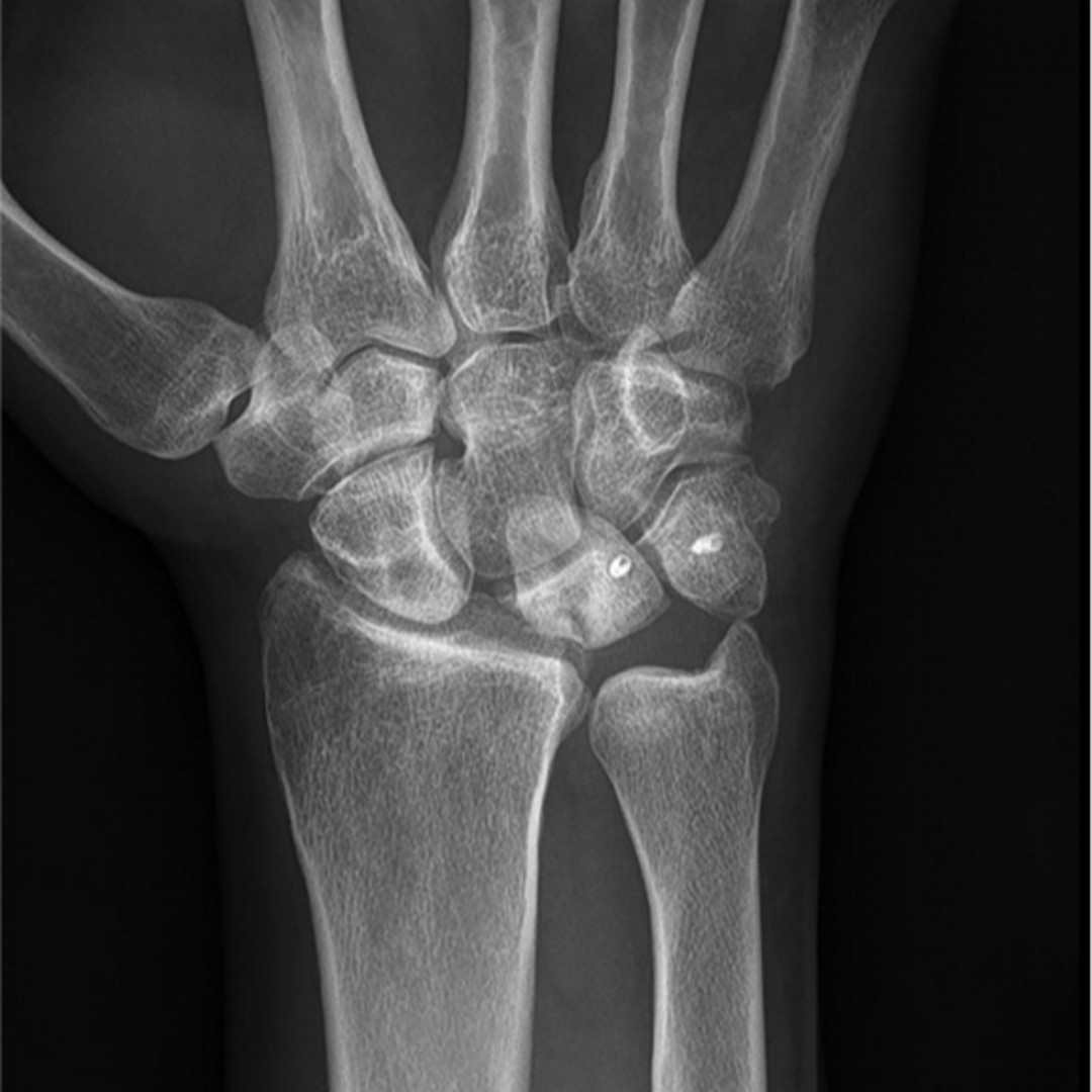 The Bone & Joint Journal (@bonejointj) on Twitter photo This study evaluated early clinical, patient-reported, and radiological outcomes of the scapholunate ligament 360° tenodesis technique for treatment of scapholunate instability.
<a href="/sanjkakar/">Sanj Kakar MD</a> <a href="/AnthonyLogliMD/">Anthony L. Logli, M.D.</a> <a href="/RamazanianTaghi/">Taghi Ramazanian MD</a>
<a href="/jrfowlermd/">John Fowler</a>
ow.ly/PegT50HpoJt This study evaluated early clinical, patient-reported, and radiological outcomes of the scapholunate ligament 360° tenodesis technique for treatment of scapholunate instability.
<a href="/sanjkakar/">Sanj Kakar MD</a> <a href="/AnthonyLogliMD/">Anthony L. Logli, M.D.</a> <a href="/RamazanianTaghi/">Taghi Ramazanian MD</a>
<a href="/jrfowlermd/">John Fowler</a>
ow.ly/PegT50HpoJt