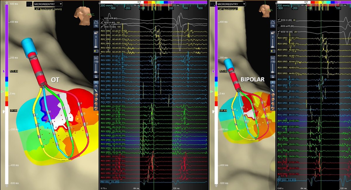 #OmnipolarTechnology showcases a microreentry flutter in a single acquisition. OT EGMs are individually corrected to align to the wavefront providing the true EGM. 3x enhanced point density provides increased specificity to correctly exhibit the entire circuit.