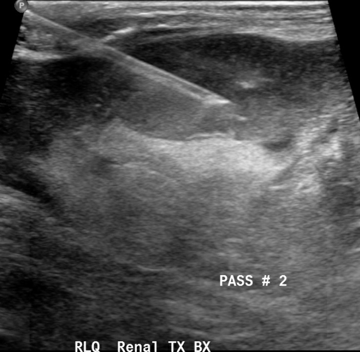 virmani_sar's tweet photo. I absolutely love using the #linearprobe for really superficial #kidneytransplant #biopsy. This one being done for #nephrotic range proteinuria. @yaletxpneph
Anyone else switch between the probes ?
@AST_KPCOP @AschWilliam @YaleRadiology
@RandyLucianoMD @NephroP https://t.co/XJoRRhThRq