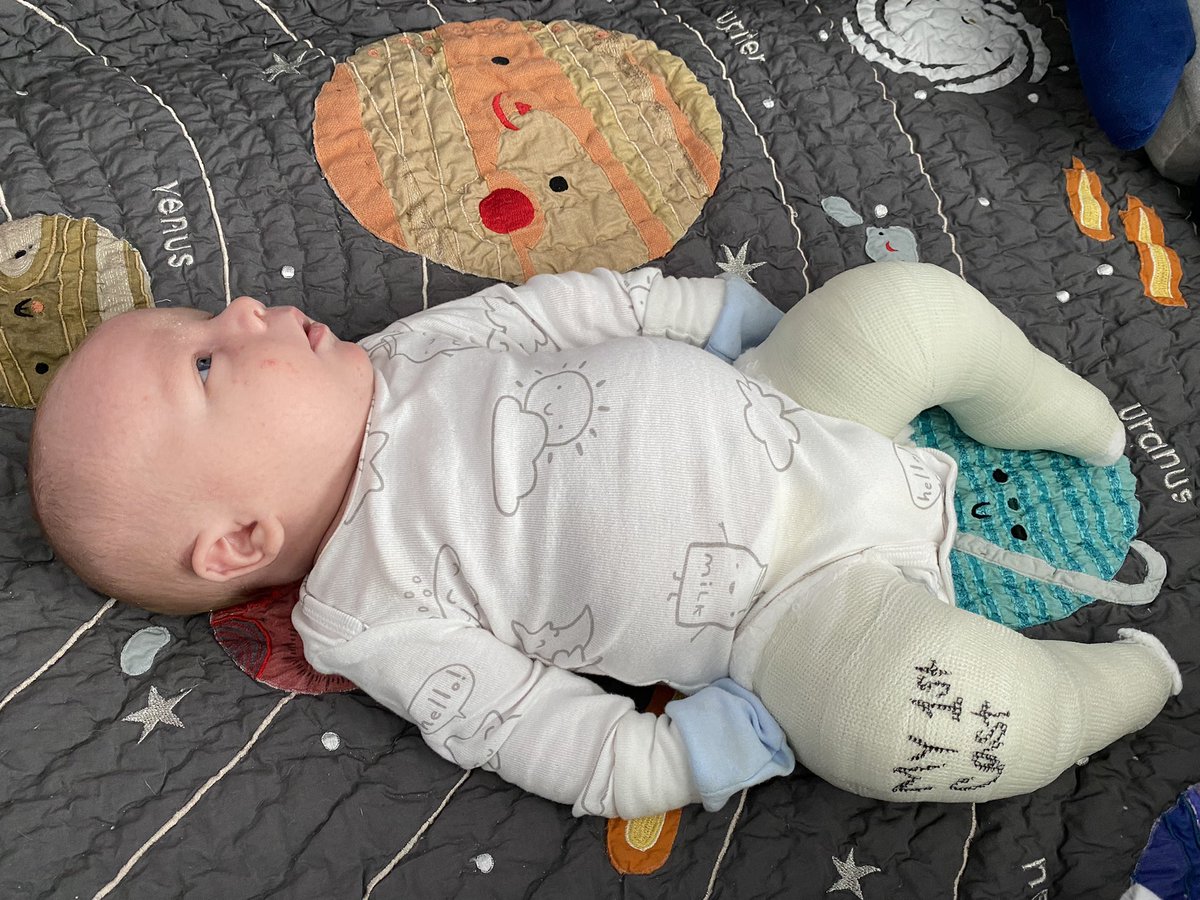 cmgruenberg's tweet photo. 1️⃣ month old!
Time is flying by with this little guy. He got his 1st set of casts yesterday for his club feet. He also had his 1 month check up this morning and weighs 13.8lbs (with the casts). #clubfootcutie #firstcast #clubfoot #1monthold https://t.co/S0R0R69pwy