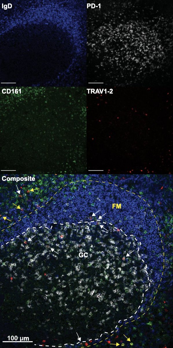 Science Immunology (@sciimmunology) on Twitter photo New research from <a href="/UofUMedicine/">Spencer Fox Eccles School of Medicine</a> identifies a special set of #MAIT mucosal T cells found in tonsil tissue that support B cells in fighting bacterial infection. fcld.ly/4ukauk2 New research from <a href="/UofUMedicine/">Spencer Fox Eccles School of Medicine</a> identifies a special set of #MAIT mucosal T cells found in tonsil tissue that support B cells in fighting bacterial infection. fcld.ly/4ukauk2