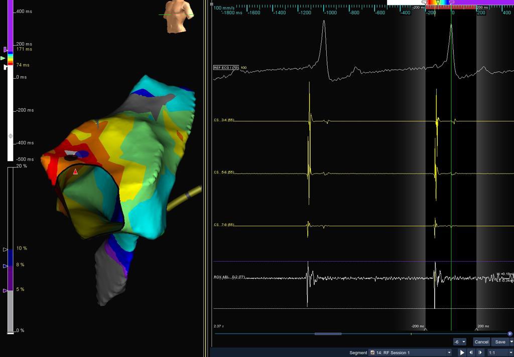 mertilkerh's tweet photo. Ablated from tricupid anterolateral region, thanks for the map @vebedu https://t.co/lI5S2cNVoE