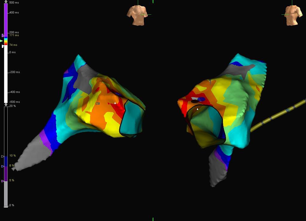 mertilkerh's tweet photo. Ablated from tricupid anterolateral region, thanks for the map @vebedu https://t.co/lI5S2cNVoE