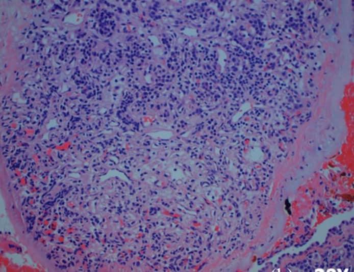 A rare #glomangioma of the middle ear. What’s the difference between a real #glomus tumor and a “glomus” tympanicum?  Read our paper to find out.  #paraganglioma 

A rare case of a middle ear glomangioma
journals.sagepub.com/.../10.1177/20….

<a href="/MaggieWieserMed/">Maggie Wieser</a>
<a href="/gravyfloats/">Jason May</a>