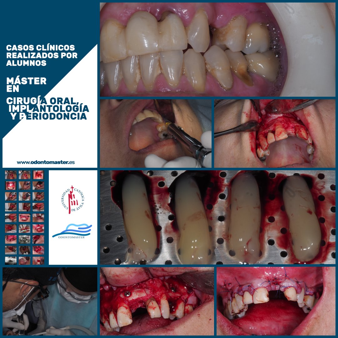 odontomaster_es's tweet photo. Casos clínicos realizados durante el máster de implantes en Brasil (residencia hospitalaria): Injerto de rama mandibular

Máster en Cirugía Oral, Implantología y Periodoncia.
60 créditos ECTS.
Alicante.

https://t.co/aq55Yq3Z2B

@odontomaster_es @ucavila_ @esteveformacion https://t.co/d8GLsl5t1z