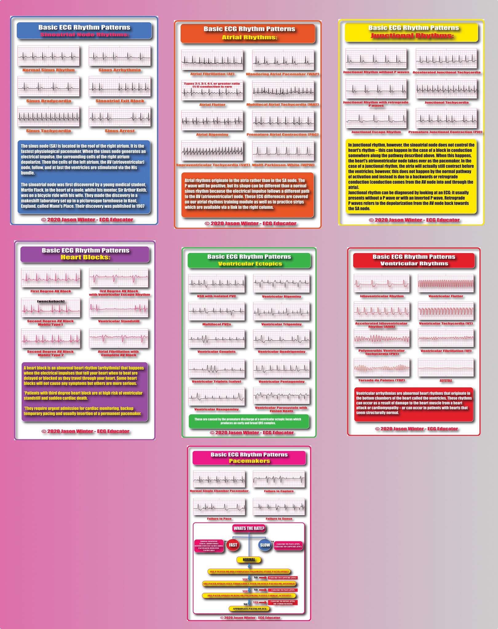 Idioventricular Ekg Rhythm Strips Hot Sex Picture