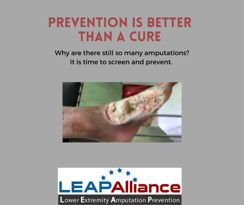 PatientDay's tweet photo. Why are we still amputating legs? Patients who have a PAD are at higher risk of serious health problems or even amputation. Having an amputation can also shorten life. #LEAPAlliance offers free screenings.  #prevention #amputation #limbloss #peripheralarterydisease #PAD #diabetes https://t.co/c65zDeQStV