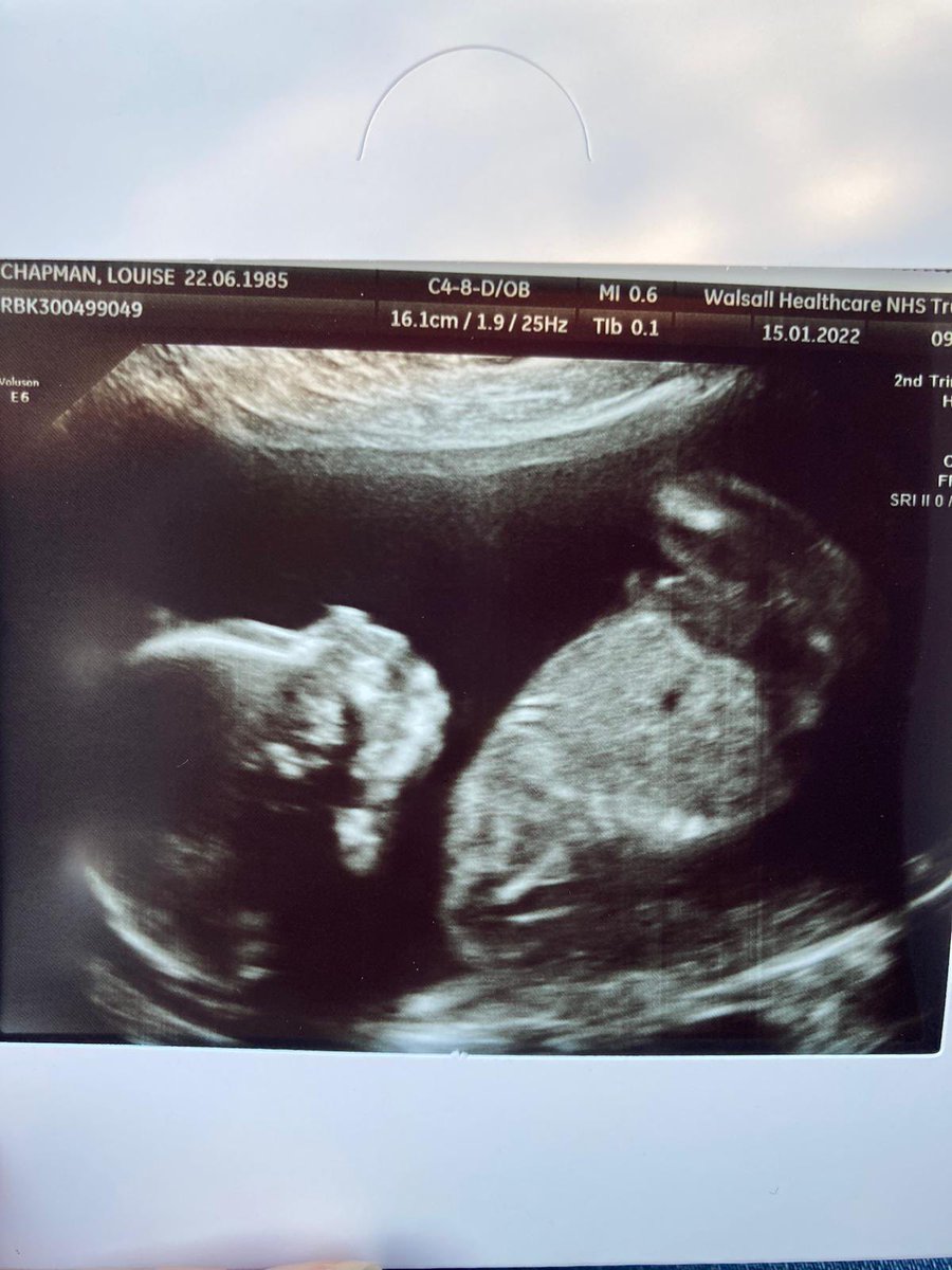 chapmanbcfc's tweet image. One healthy Baby Chapman cooking nicely 💙/💖

@MissJones2206 

#20weekscan #littlebluenose #healthybaby #naughtybaby #rainbowbaby #boyorgirl #BSHLOUT