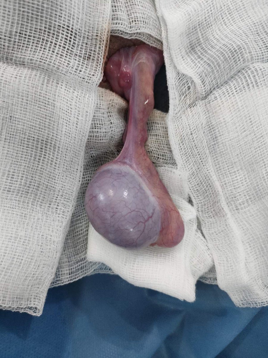 Kives voi kiertyä vartensa ympäri aiheuttaen verenkierron salpaantumisen = kiveksen kiertymä = #testistorsio 

Kiveksen kiertymällä kaksi esiintyvyyshuippua: vastasyntyneellä ja murrosiässä.

Kuva: <a href="/benatta2010/">benatta mahmoud</a> / erikoistuva 🇩🇿