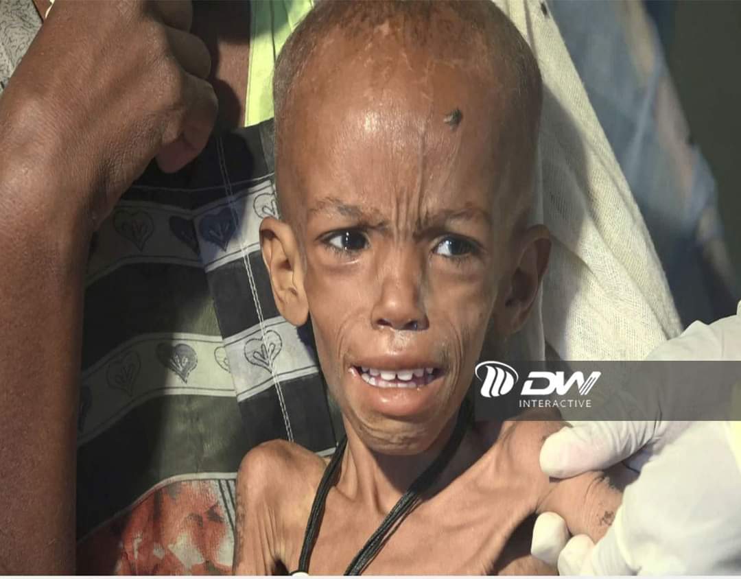 hailu_abraha's tweet photo. This's the true face of #Tigrayan kids. While more 6 million people in #Tigray has no bread left on the table, the international community has been using the leap service wordage " deeply concerned" as a solution to the catastrophy.
#Stopmanmadefamine
@USAmbUN @EU..
@UN_HRC https://t.co/YNhylwdL5n