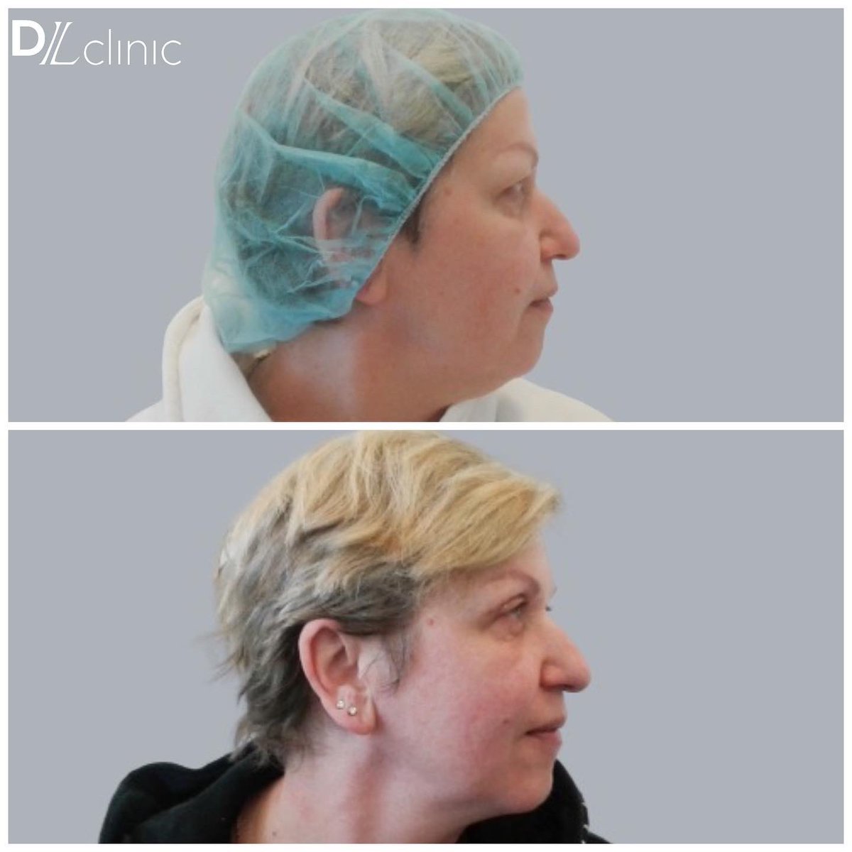 Блефаропластика относится к малоинвазивным процедурам с несложным хирургическим вмешательством и при этом даёт мощный эффект омоложения.

На фото результат операции:

✅ Взгляд стал более открытым 
✅ Больше нет эффекта “усталых” глаз
✅ Минус 10 лет
#пластическийхирургспб