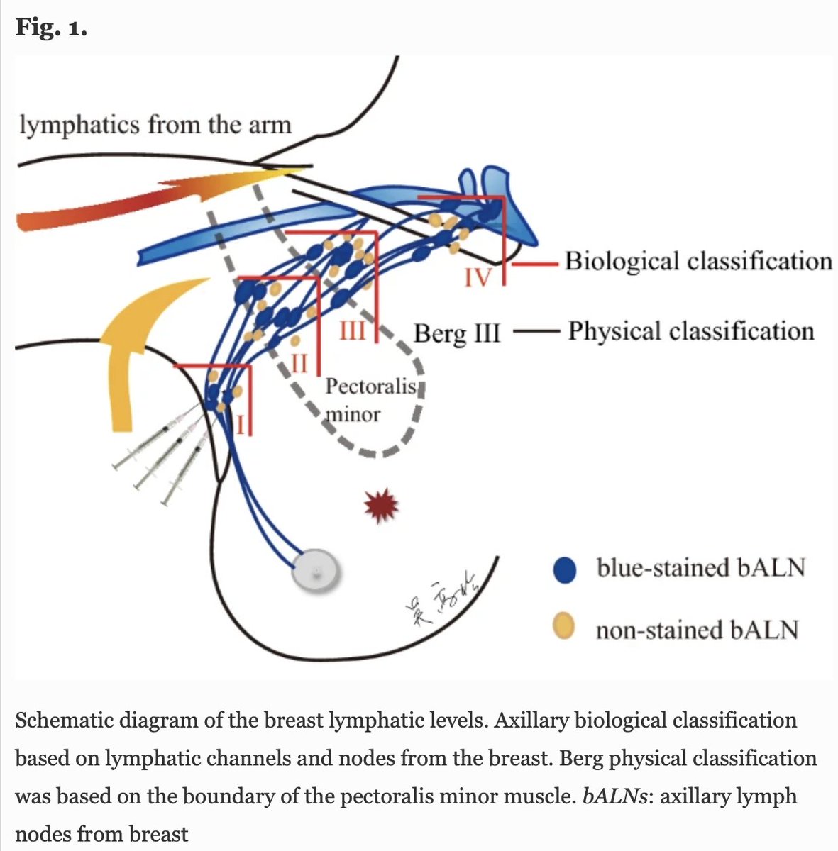 AnnSurgOncol's tweet image. JANUARY ISSUE: Stepwise Limited Axillary #LymphNodeDissection Based on #LymphaticDrainage from the Breast to Decrease #BreastCancer-RelatedLymphedema: A Randomized Controlled Trial.rdcu.be/cESOm @McMastersKelly @SocSurgOnc