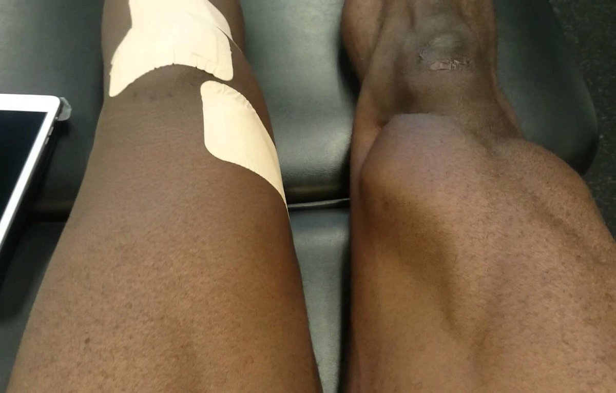 ACLrecoveryCLUB's tweet photo. Quad atrophy is real &amp; should be expected after ACL surgery. You’ll spend most of your rehab time working on getting it to fire again! #NeverQuit https://t.co/zox1NkY0vt