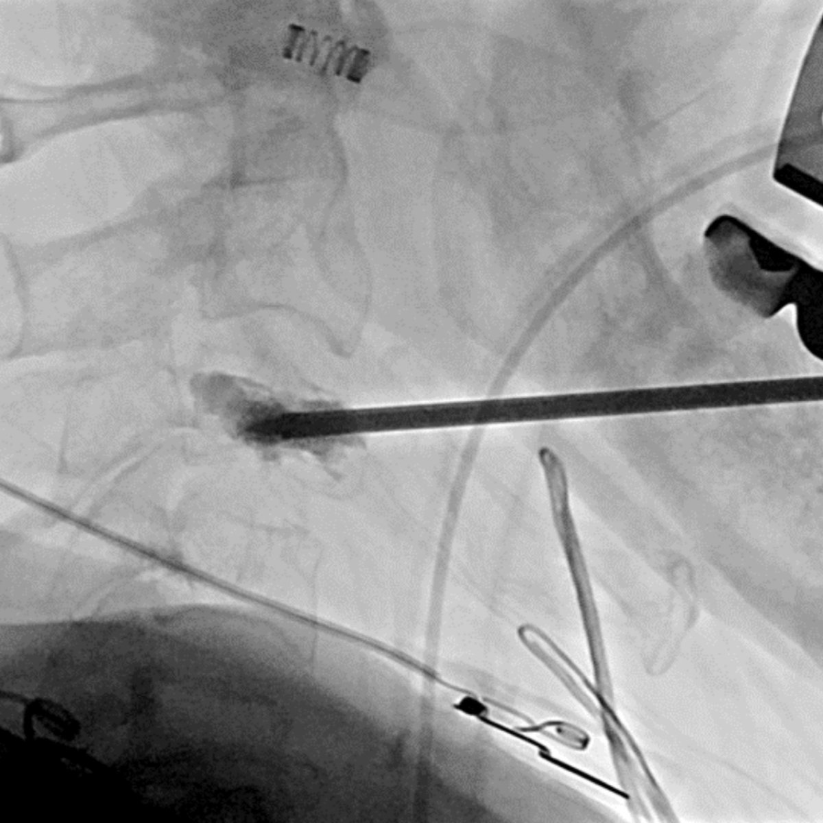 ucsd_ir's tweet photo. Trans-oral cervical vertebroplasty of
C3 and C4 in a patient with painful
cervical fractures 2/2 rectal
osseous metastatic disease. Great
teamwork with our DR and IR residents
Smita Patel, Peter Abraham and sub-l
@PriIRAD with @SeanTutton and Dr
Tadros leading the pack. 💪 https://t.co/dhrESyRdO7