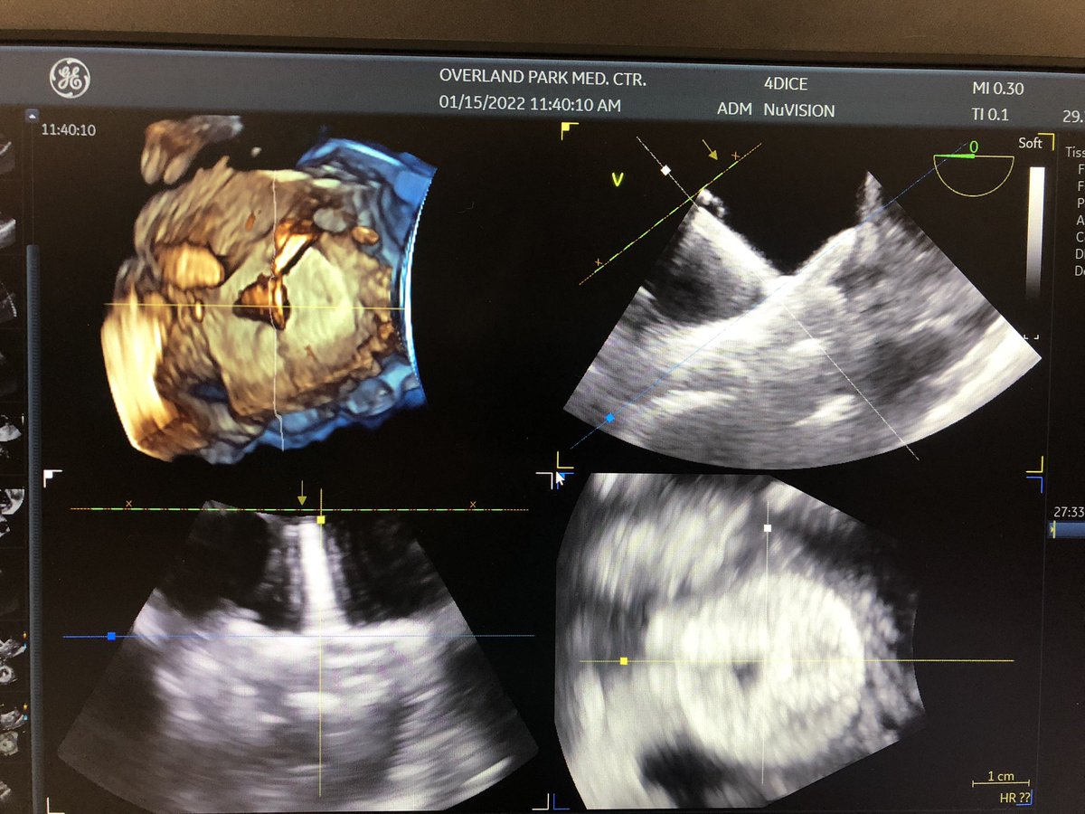 DJ_Lakkireddy's tweet photo. Big round of 👏🏻👏🏻to @KCHRI1 team for making an excellent Amulet LAAO live case happen amidst snow and slurry for #AFS2022 @MoussaMansour10 @VivekReddyMD @natale_md @LuigiDiBiaseMD @aalahmadmd @JAFIB_ @cellisvandyep @RPHortonMD @AbbottCardio @HCAMidwest @OPRMC @HCAhealthcare https://t.co/Pg7AtiV63I