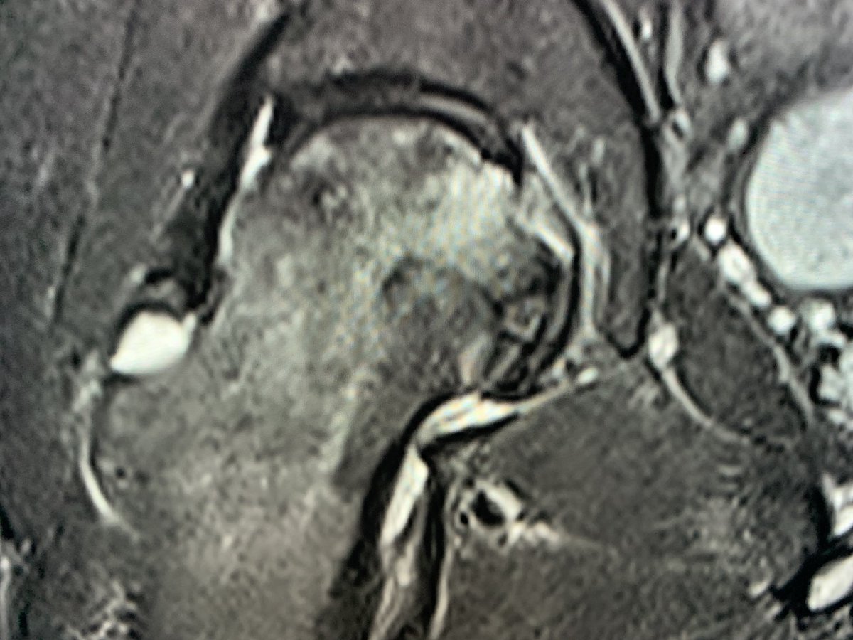 northwoods1980's tweet photo. Bilateral AVN, easily seen on the x-rays. https://t.co/I6xRaEwbvq