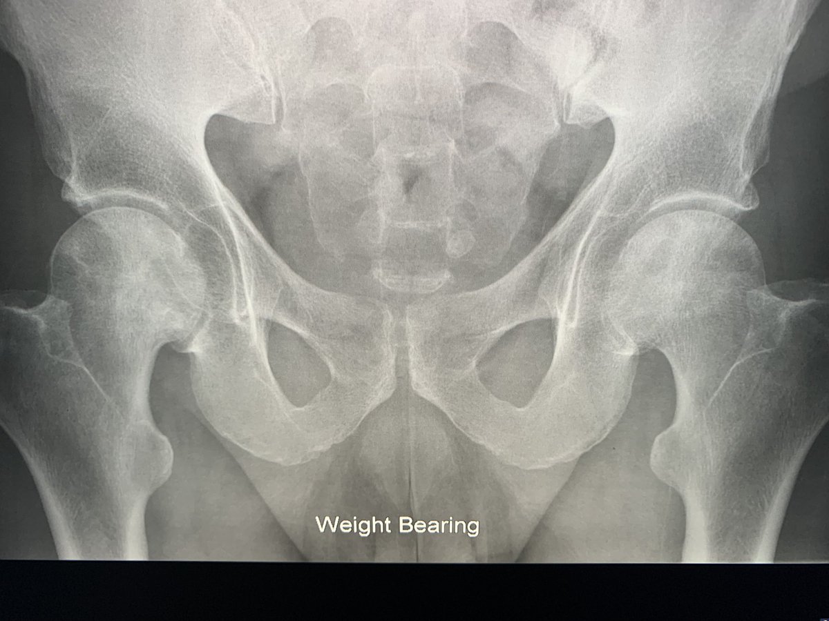 northwoods1980's tweet photo. Bilateral AVN, easily seen on the x-rays. https://t.co/I6xRaEwbvq