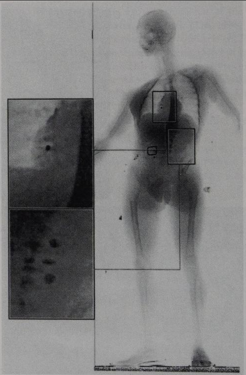 Ibl3D's tweet photo. ⚫️
Full body fluoroscopy scan showing precious stones in the esophagus and gastrointestinal tract .
"A radiologic atlas of abuse, torture, terrorism, and inflicted trauma" (2003) https://t.co/YCiP9YDQBs