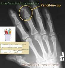 Pencil In Cup Deformity Psoriatic Arthritis 