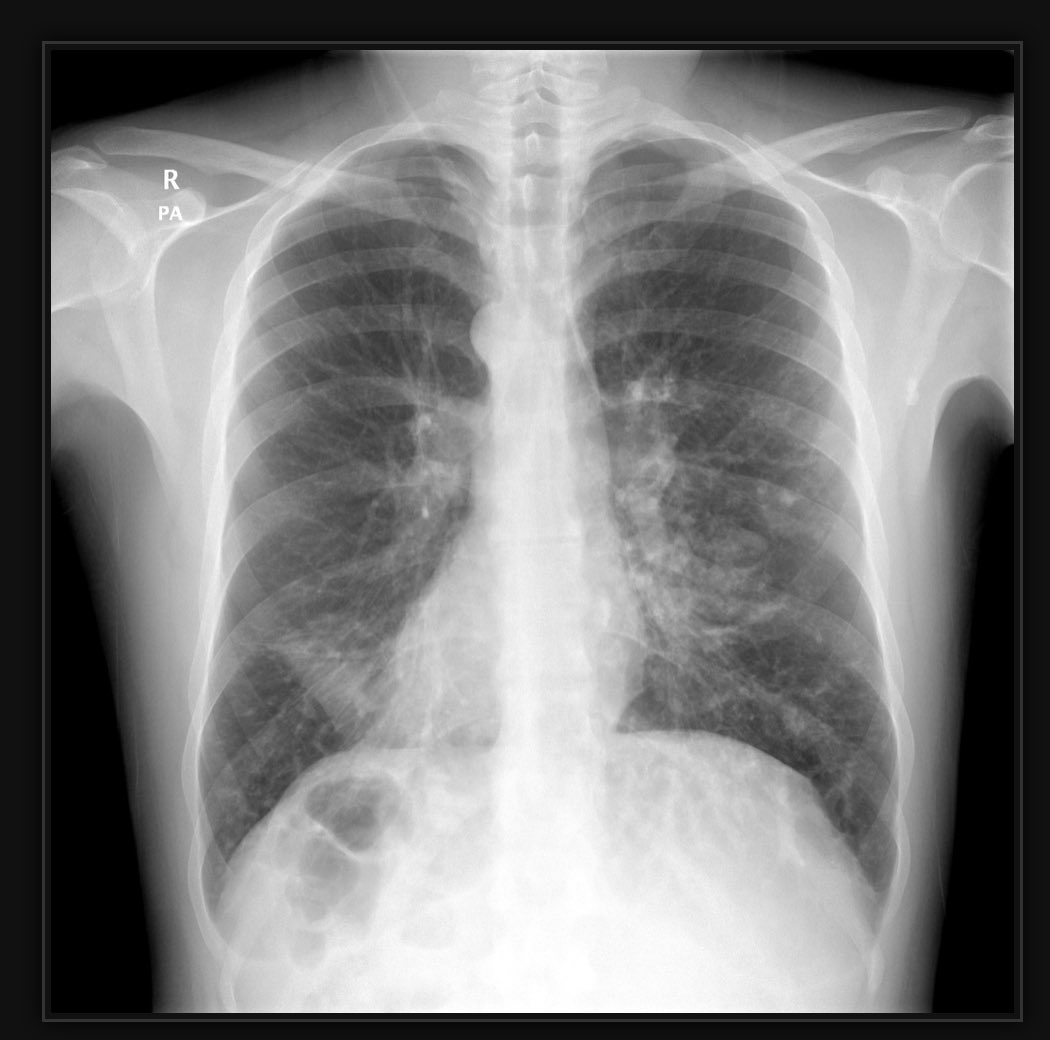 Radiology Twitter Tweet: What is situs inversus?
Situs inversus is a genetic condition in which the organs in the chest and abdomen are positioned in a mirror image from their normal positions. For example, the left atrium of the heart and the left lung are positioned on the body’s right side. 
#XRAY https://t.co/C8rKcKIRJ6