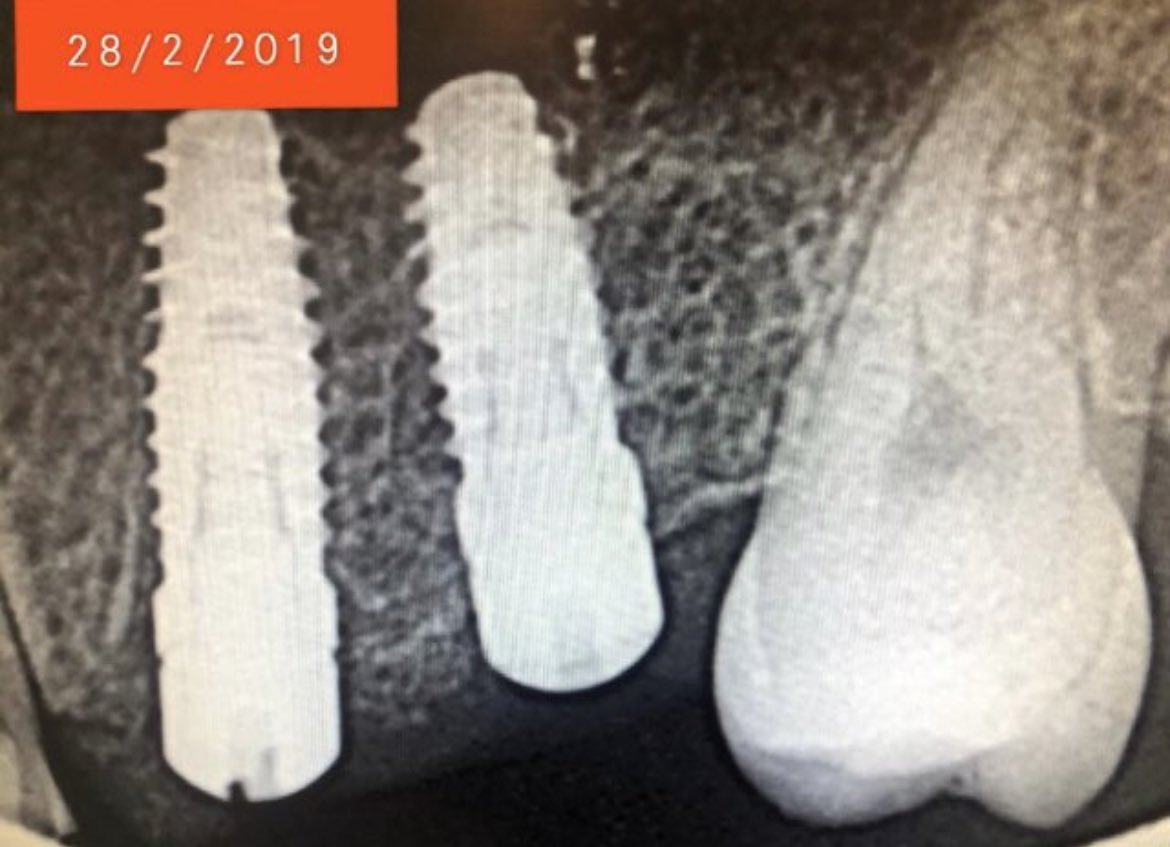dr_bishi's tweet photo. عمل الزراعات و ��الخطوات و الدقه المطلوبه و متابعه الحاله الى انتهاء التركيب و المتابعه بعد سنوات في هذي الحاله و كيف ان العظم حول الزراعات بنفس الوضع اللي كان عند زراعتها @Okclinics @SianMedical @DentallyDental https://t.co/6zwgLtc0CE