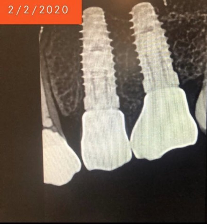 dr_bishi's tweet photo. عمل الزراعات و ��الخطوات و الدقه المطلوبه و متابعه الحاله الى انتهاء التركيب و المتابعه بعد سنوات في هذي الحاله و كيف ان العظم حول الزراعات بنفس الوضع اللي كان عند زراعتها @Okclinics @SianMedical @DentallyDental https://t.co/6zwgLtc0CE