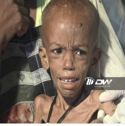 SamBekeleGerba's tweet photo. Whenever we sit to dine let’s remember these kids from Tigrai! They don’t know about Debretsion or Abiy, they don’t have any say in this war but they are  number 1 victim of the war. @AbiyAhmedAli could end this starvation in a minute. But he chose not to. Always Remember That! https://t.co/dJqVFeaffE