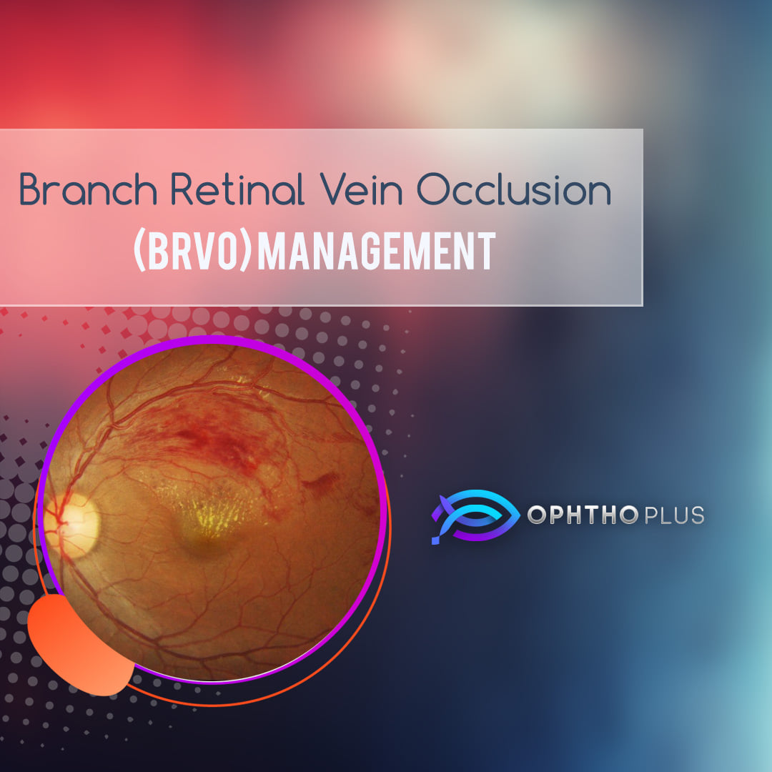 ophthoplus's tweet image. #BRVO
#retina
Branch Retinal Vein Occlusion (BRVO) management ⬇️
Visit our Instagram account: ⬇️
instagram.com/ophthoplus
Our Facebook page: ⬇️
facebook.com/ophthoplus