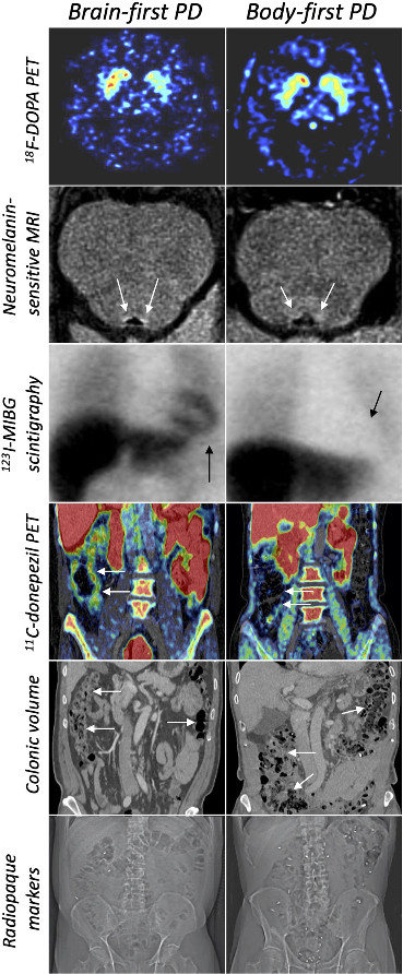 A useful new review exploring clinical &amp; imaging evidence of the brain-first vs body-first models of #Parkinsons; They "might be two distinguishable entities on some clinical- &amp; imaging markers"
sciencedirect.com/science/articl…
