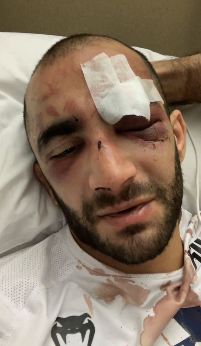 Current_MMA's tweet photo. Giga Chikadze from hospital right now 😳. https://t.co/w2uyHQHmT6