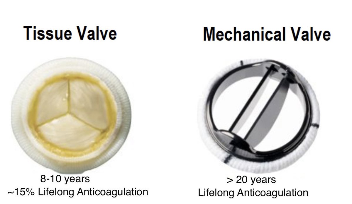 RowseMD's tweet photo. ⬇️risk of thromboembolism following SAVR with a bioprosthesis is, perhaps, the most common misconception in the selection of a heart valve substitute

The rate of thromboembolic complications following SAVR is  0.5% to 1% per year with either biological or mechanical. https://t.co/7RP6t6THoQ