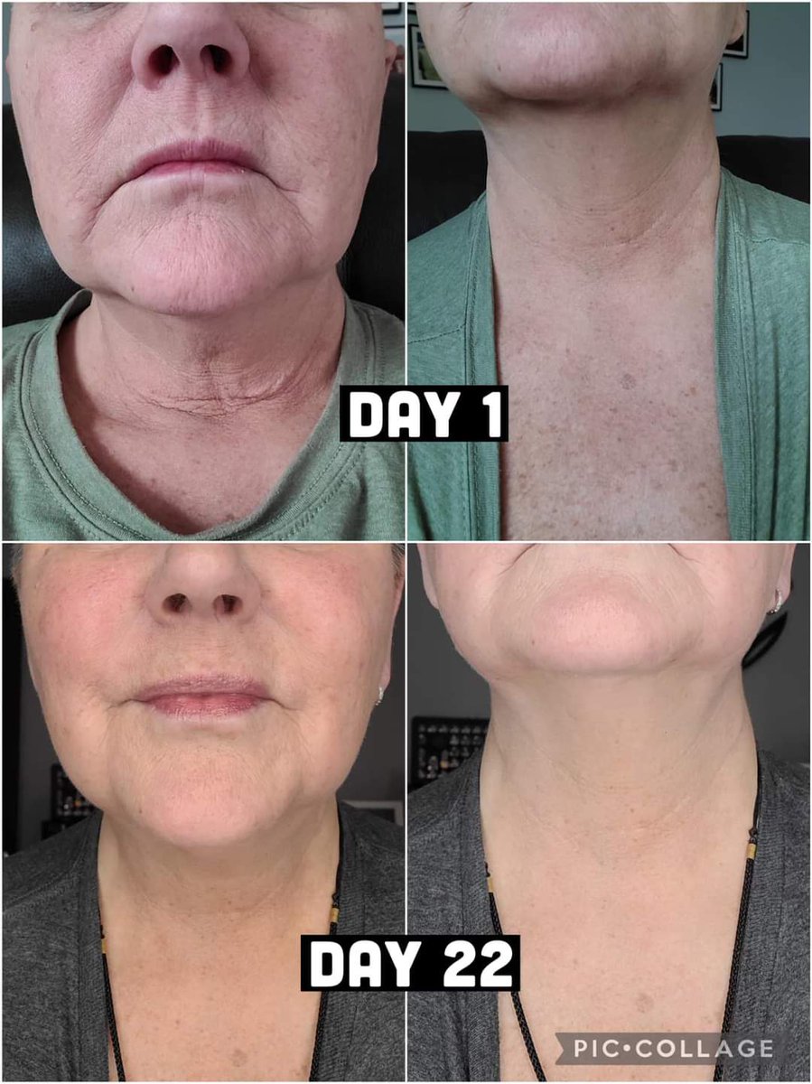 LSUKAT4's tweet photo. From my friend Lisa...
🤯🤯🤯 Today is just Day 22 🤯🤯🤯
My 53 year old skin is tighter, brighter, smoother and so hydrated!!! I will never stop using this product!!
#Collagen #LiquidCollagen #BeautyFromTheInside #BeautyByCasie https://t.co/Ock3Pe1vl6