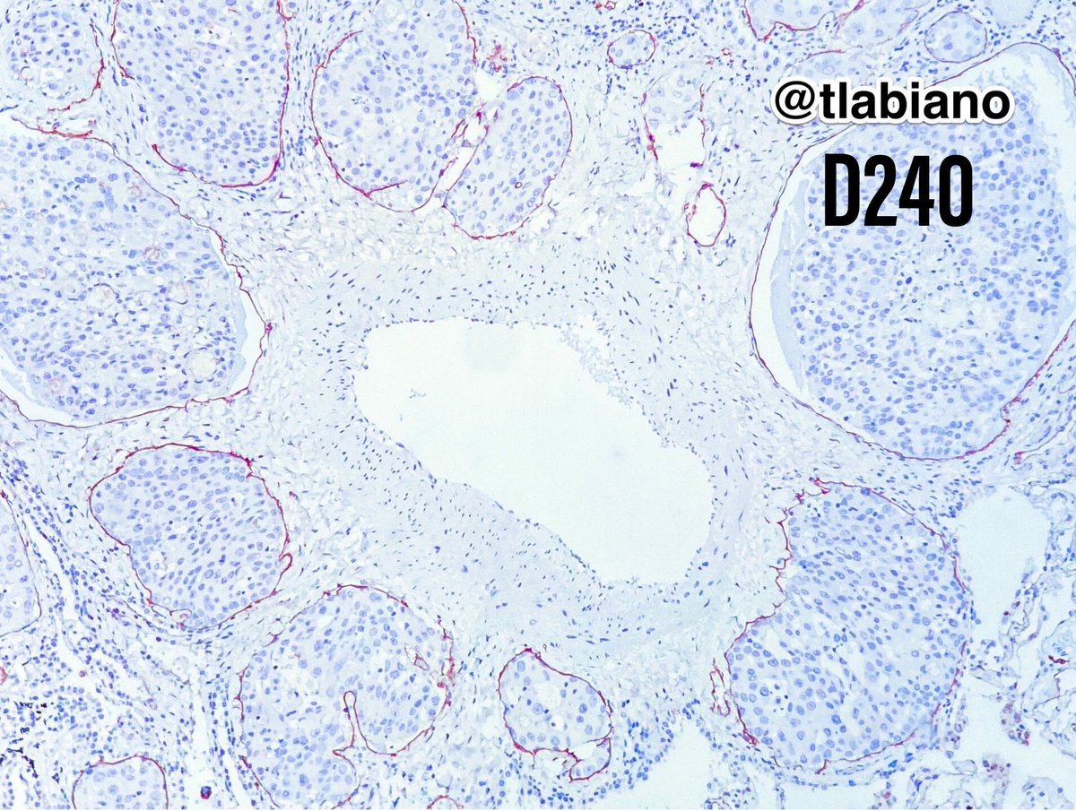 Pulmonary lymphangitic carcinomatosis- Lymphatic vessels occupied by tumor nests around a pulmonary artery. 
#pulmpath 🫁 #lungcancer