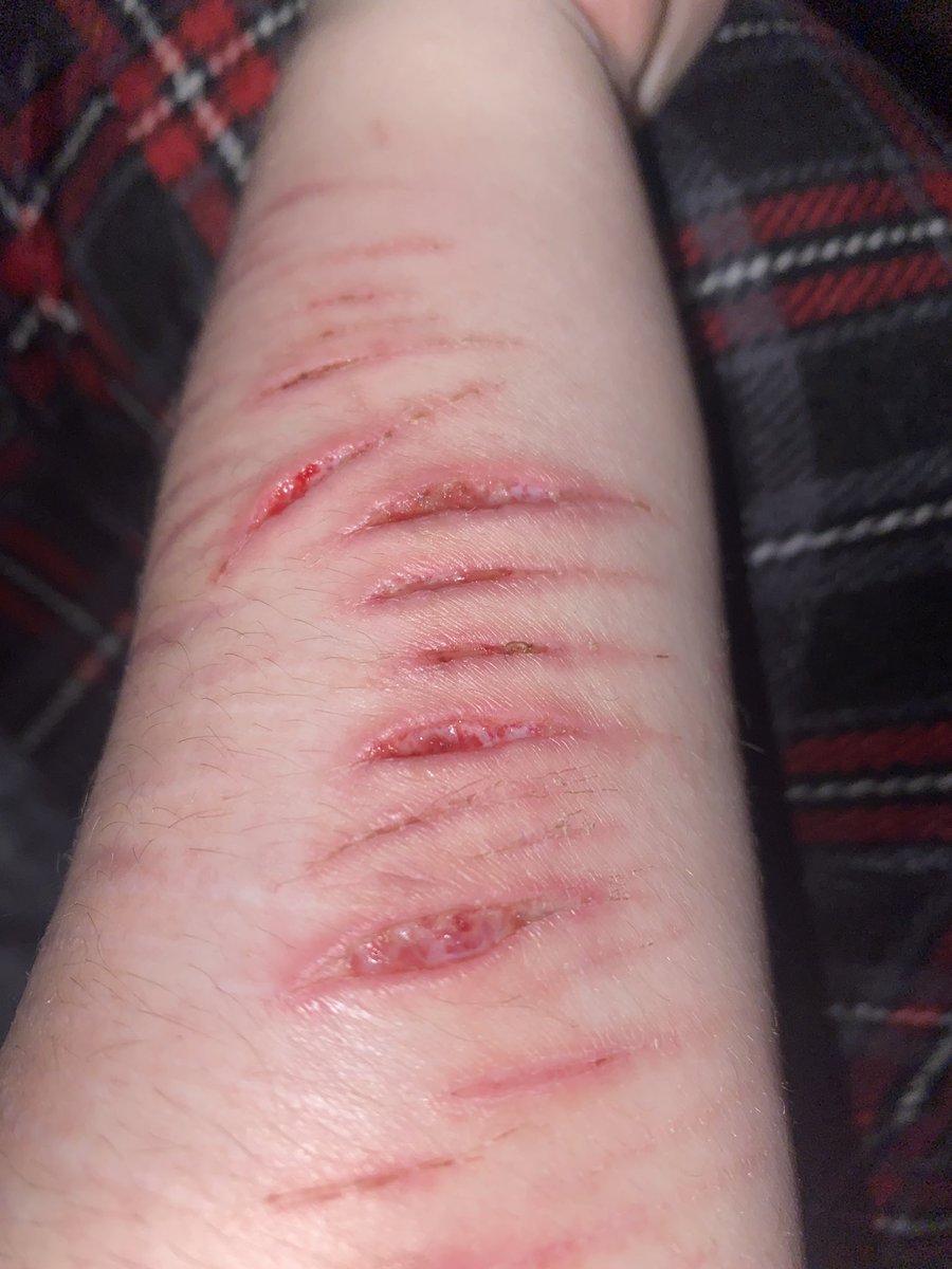 prorecovery's tweet photo. Are these healing okay??#shtwt #beanstwt #armgills #madeofstyrofoam https://t.co/MtL8Cn7363