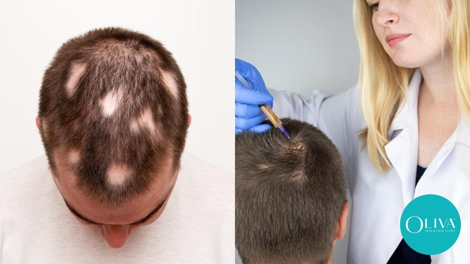 Oliva Skin and Hair Clinic on Twitter: Oliva Skin and Hair Clinic on Twitter: