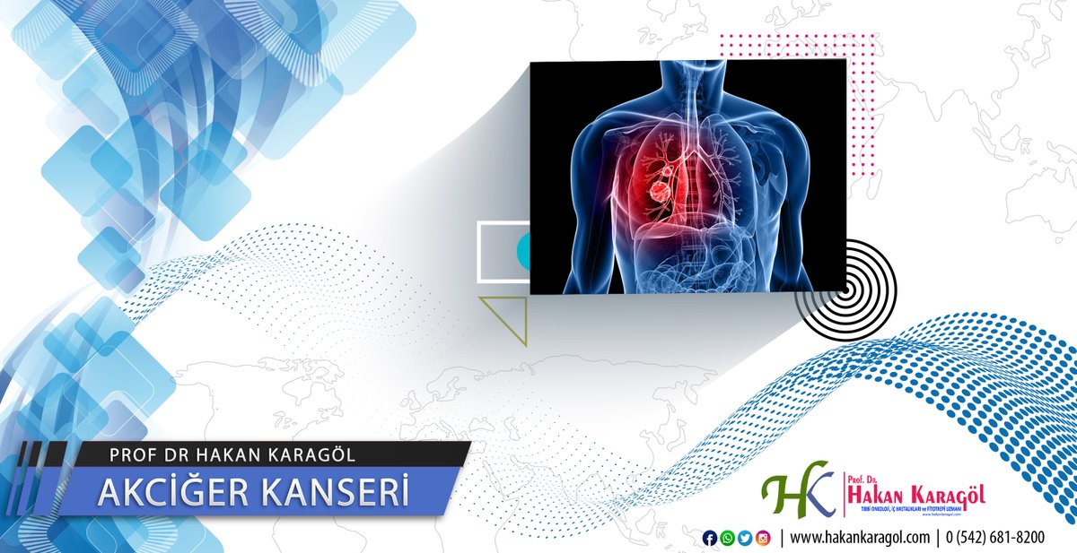 AKCİĞER KANSERİ
Akciğer kanserleri en sık görülen kanser türüdür. Bu hastalık, bazen erken evrede bulgu verir iken,
Devamı..
hakankaragol.com/kanser-ve-teda…

Prof Dr Hakan Karagöl
#akcigerkanseri #profdrhakankaragol #drhakankaragol

Hızlı İletişim: 0(542) 681 8200
hakankaragol.com