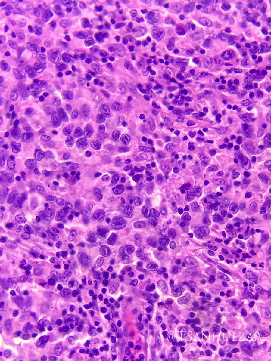 TSanhuezaA's tweet photo. Classical Hodgkin Lymphoma💜🔬
Supraclavicular lymph node. Excisional biopsy.  HE. 
#hematopath #Pedipath #Hemepath https://t.co/czQgm7uzLs