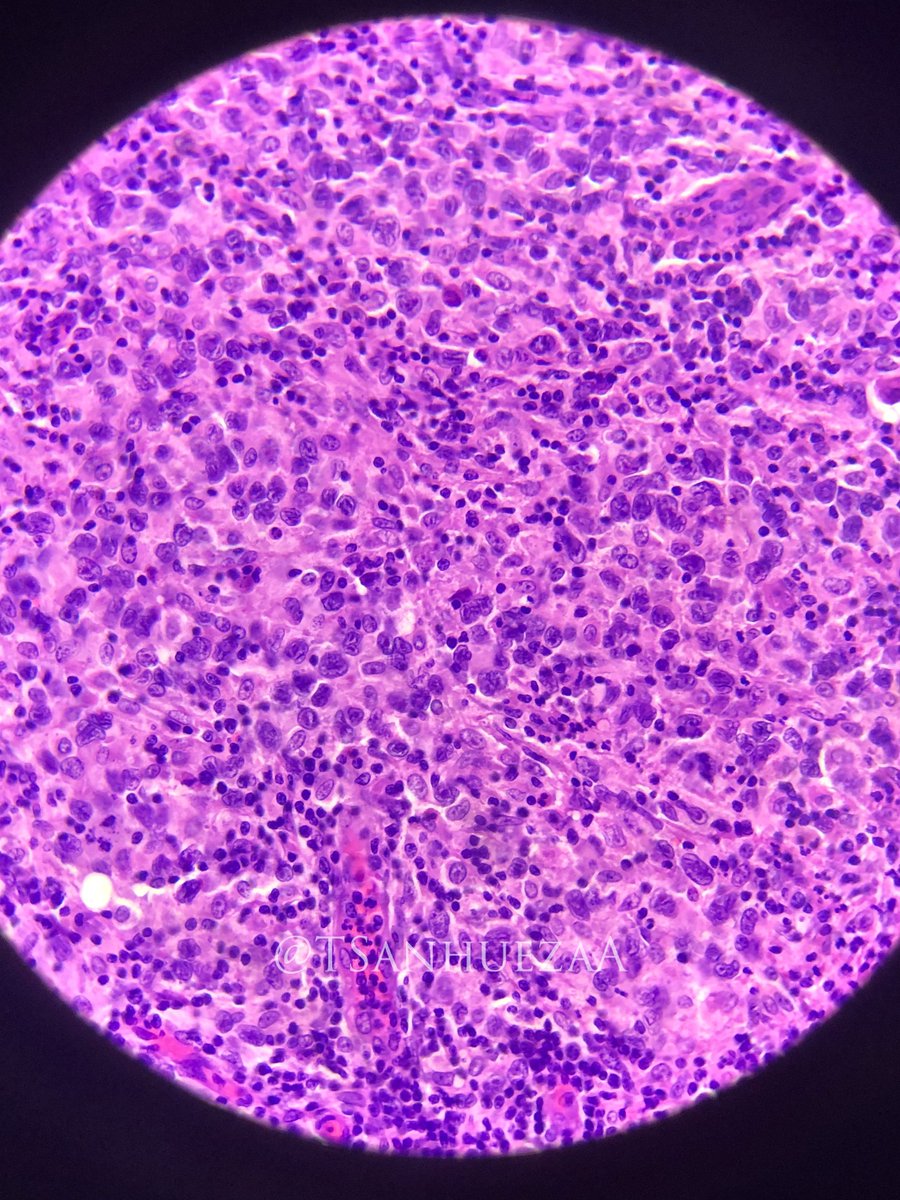 TSanhuezaA's tweet photo. Classical Hodgkin Lymphoma💜🔬
Supraclavicular lymph node. Excisional biopsy.  HE. 
#hematopath #Pedipath #Hemepath https://t.co/czQgm7uzLs