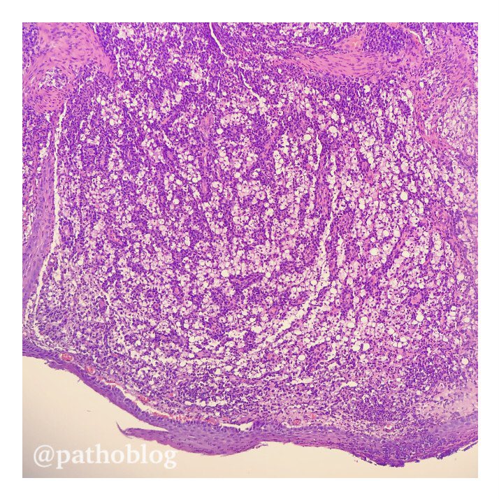 pathoblog's tweet photo. 60 y.o. male, nasal cavity mass. Dear colleagues, this is very similar to rhinoscleroma, that do you think? This disease is rare in our area. I marked Russell bodies with a yellow arrow. #pathoblog #pathology #pathologist #pathologists #pathtwitter #ENTpath https://t.co/yLe4gA6qvZ