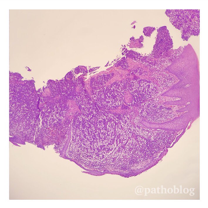 pathoblog's tweet photo. 60 y.o. male, nasal cavity mass. Dear colleagues, this is very similar to rhinoscleroma, that do you think? This disease is rare in our area. I marked Russell bodies with a yellow arrow. #pathoblog #pathology #pathologist #pathologists #pathtwitter #ENTpath https://t.co/yLe4gA6qvZ