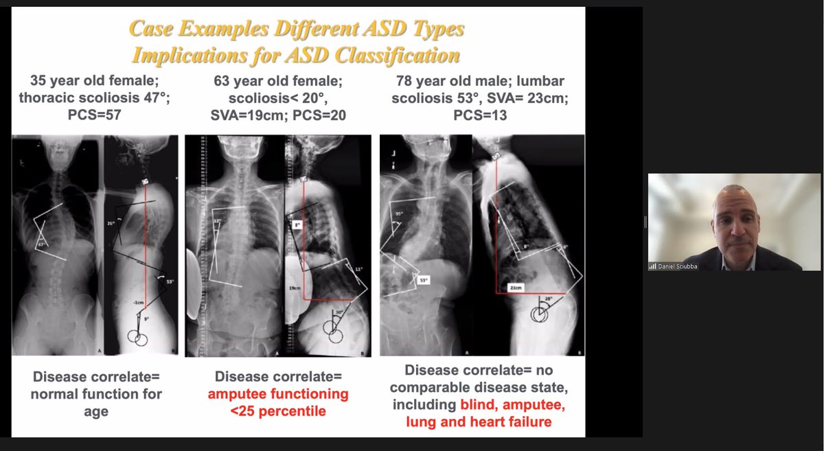 Thoughtful &amp; informative presentation on spinal oncology from our virtual visiting professor <a href="/DanielSciubba/">Daniel Sciubba</a> this morning (with nothing short of exceptional quick wit interspersed) #sweetspot