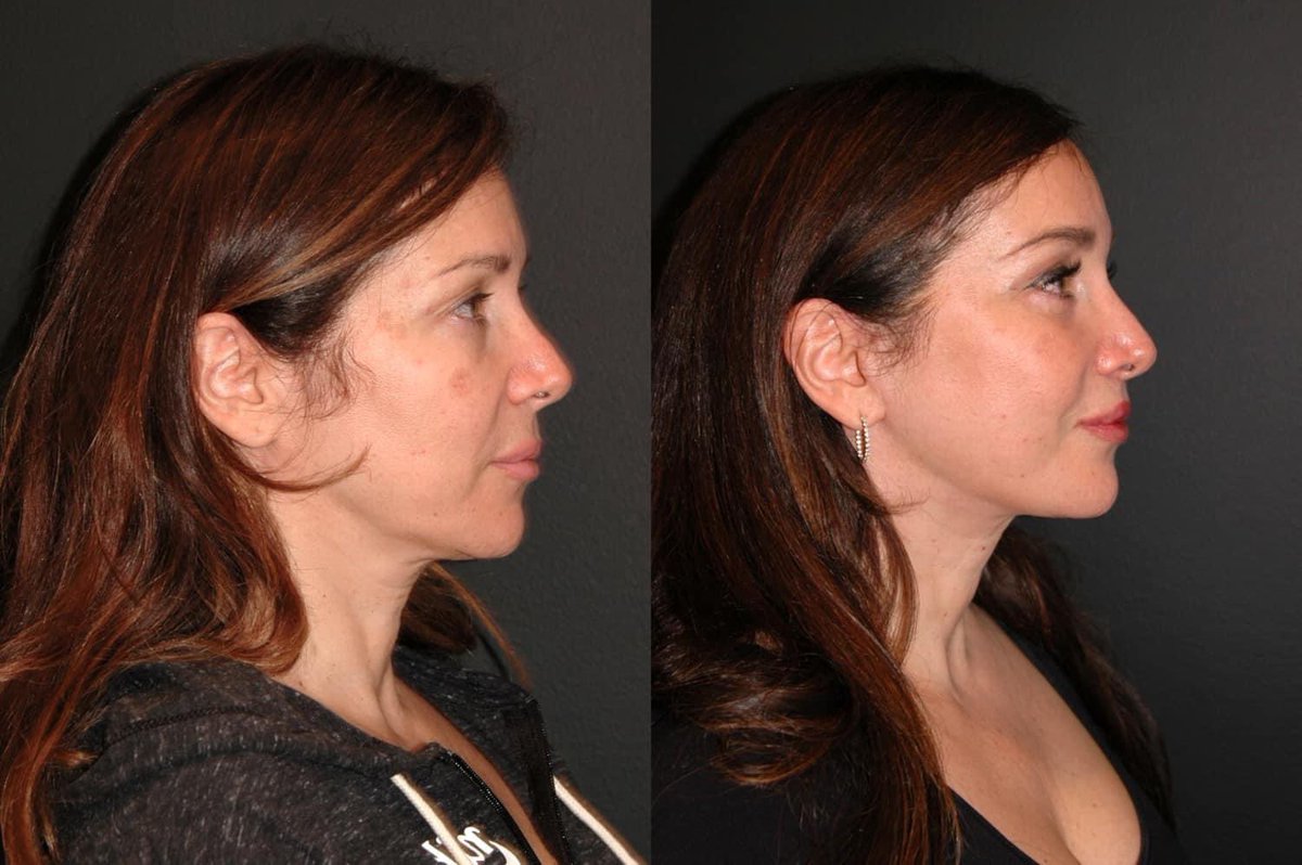 DrJacono's tweet photo. 54 year old patient of mine 3 months after I performed her #deepplsnefacelift .  Also performed a  #necklift #platysmaplasty lateral #temporallift #liplift and lower #eyelift . The #upperliplift creates the aesthetic balance that makes the whole result better!! https://t.co/g2kcieRZpQ