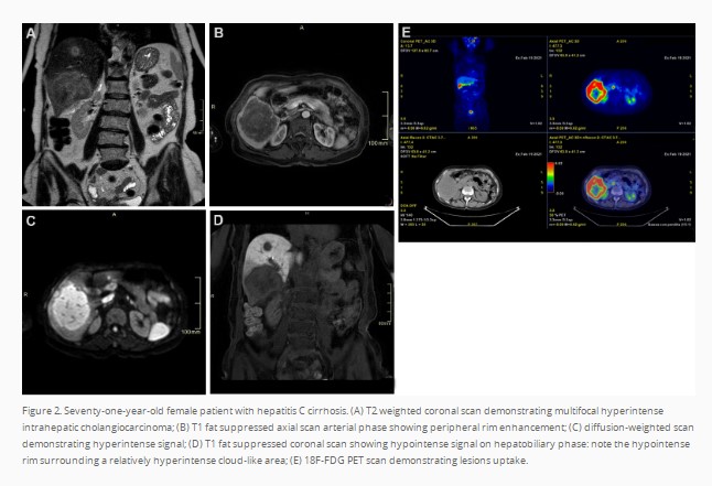 HepatomaRes's tweet photo. #livertwitter #GITwitter #MRI #CT A truly must-read on "Radiological imaging and non-surgical local treatments for cholangiocarcinoma". This is a master piece by Dr. Francesco De Cobelli's team. https://t.co/W8fVRK7W8t

@FDeCobelli @ShimaghavimiMD @LouisHSLau @vij_mukul https://t.co/hhTz0kfll0